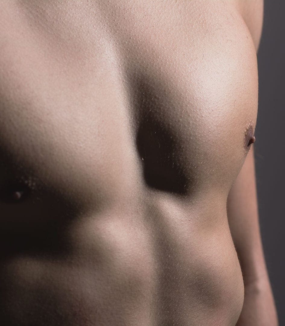 Male Breast Tissue (Gynaecomastia)