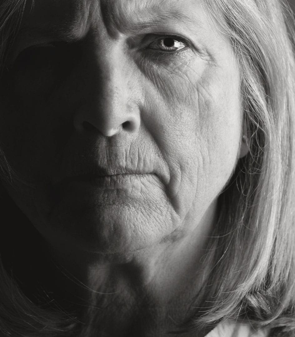 Marrionette Lines (Mouth to Chin)