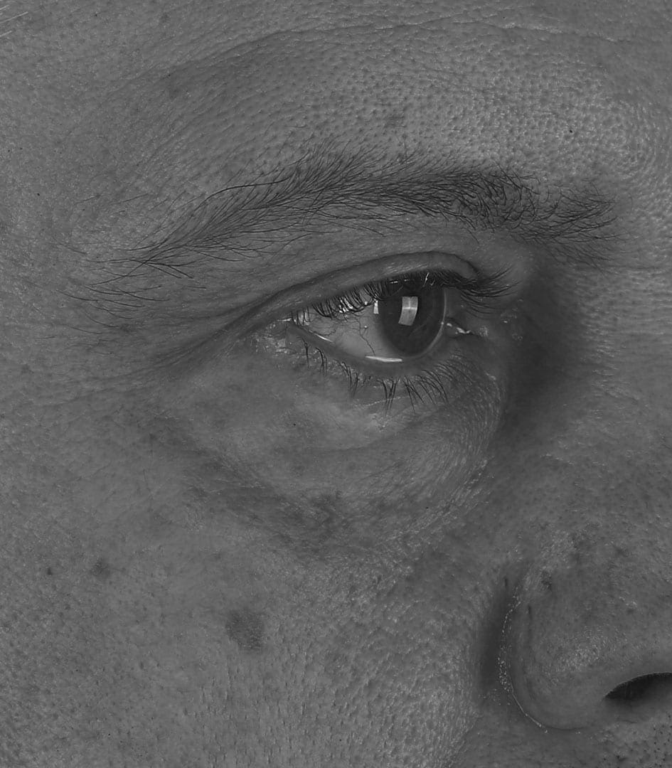 Tear Trough (Under Eye Grooves)