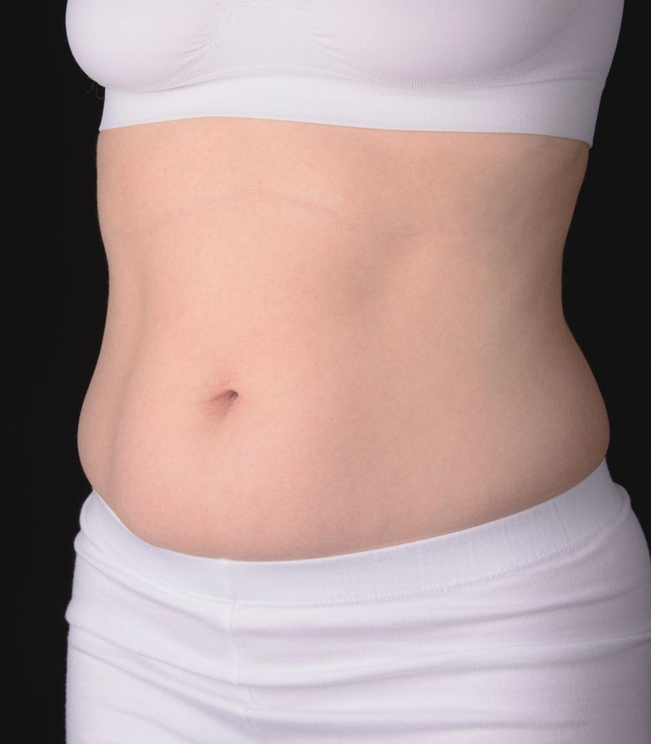 mini tummy tuck in dubai